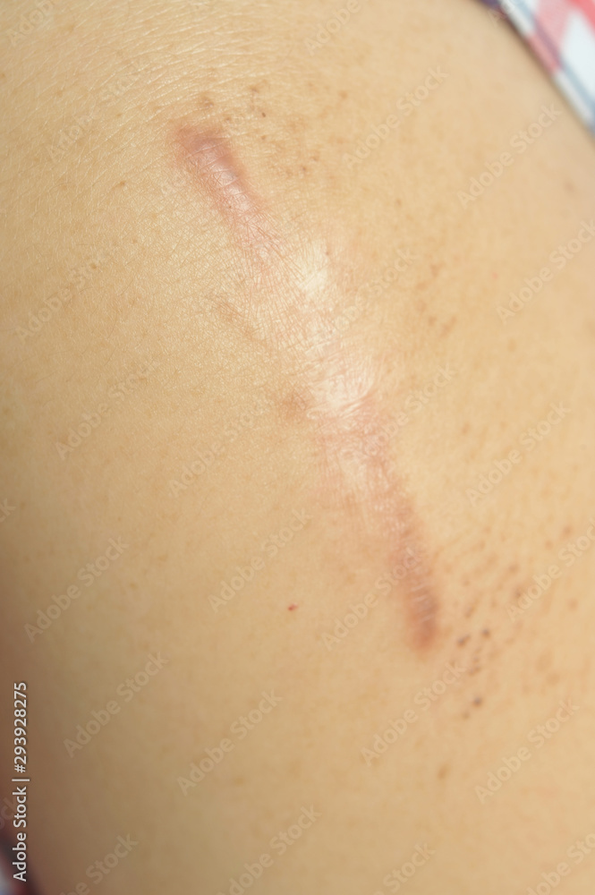 Fototapeta premium scar - a permanent effect on someone’s mind, caused by an unpleasant experience that they have had a permanent mark onwhere have been injured