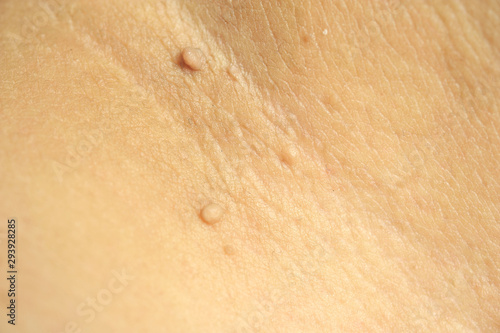 Pedunculated Mass skin tag or acrochondon or soft fibroma. Papilloma bump on male body macro shot on the Thigh