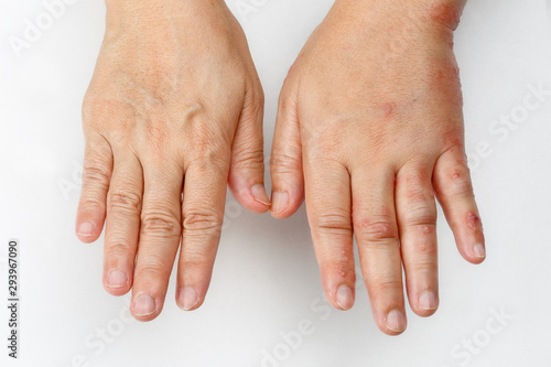 Shingles that causes a swollen hand