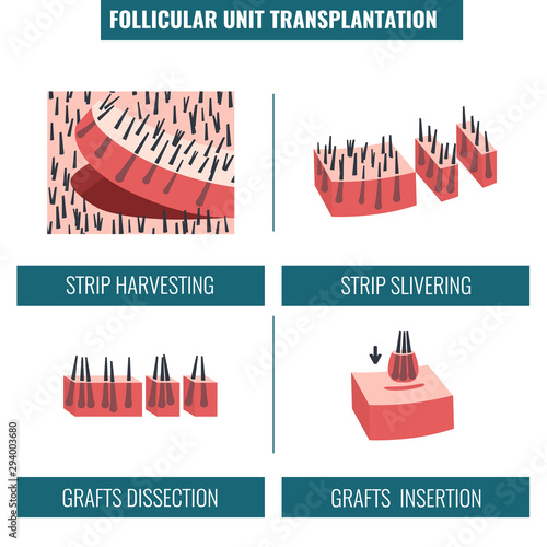 FUT hair transplantation alopecia treatment in 4 steps infographics. Stages set of follicular unit transplantation restoration surgery. Medical concept. Flat vector illustration.