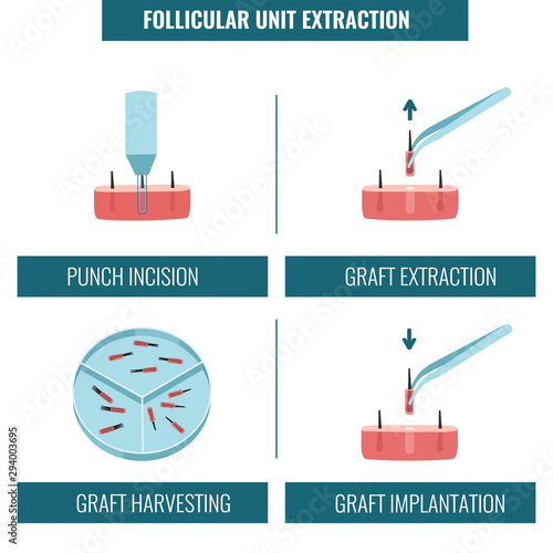 FUE hair transplantation alopecia treatment in 4 steps infographics. Stages set of follicular unit extraction restoration surgery. Medical concept. Flat vector illustration.