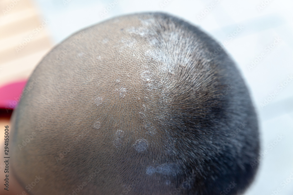 Closeup skin head , scalp, photos of dermatitis and eczema, skin