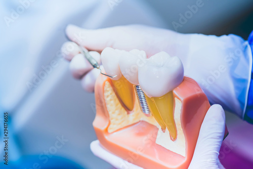 Schilderij op canvas Dentist with tooth implant false teeth