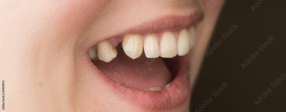 mouth with lack of tooth, teeth protetic problem