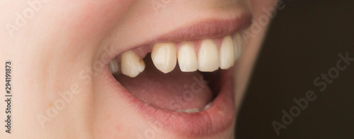 Obraz na płótnie mouth with lack of tooth, teeth protetic problem w salonie