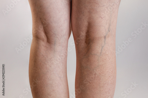 Varicose veins and medicine. Female legs close - up with vessels and the initial stage of varicose disease