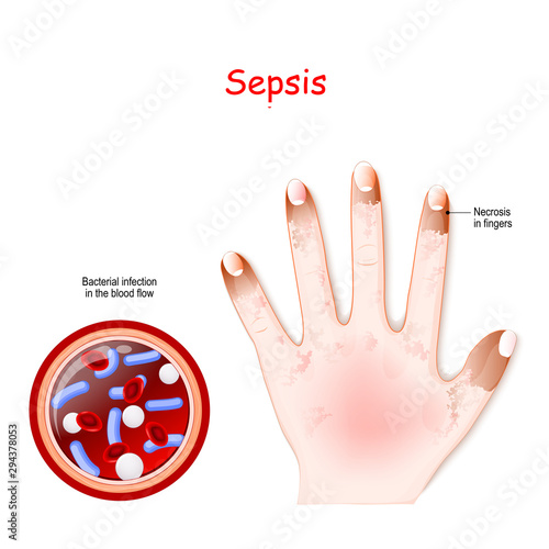 Sepsis. Close-up of cross section of blood vessel with Bacterial infection