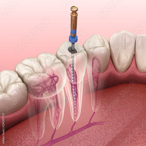 Foto Endodontic root canal treatment process