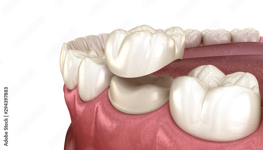 Preparated molar tooth for dental crown placement. Medically accurate 3D illustration Preparated molar tooth for dental crown placement. Medically accurate 3D illustration