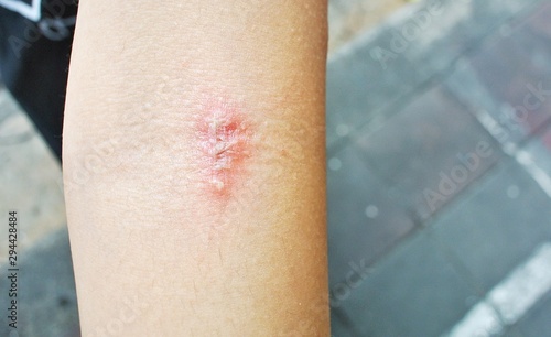 Inflammatory purulent dermatitis caused by allergies and sheep scratching