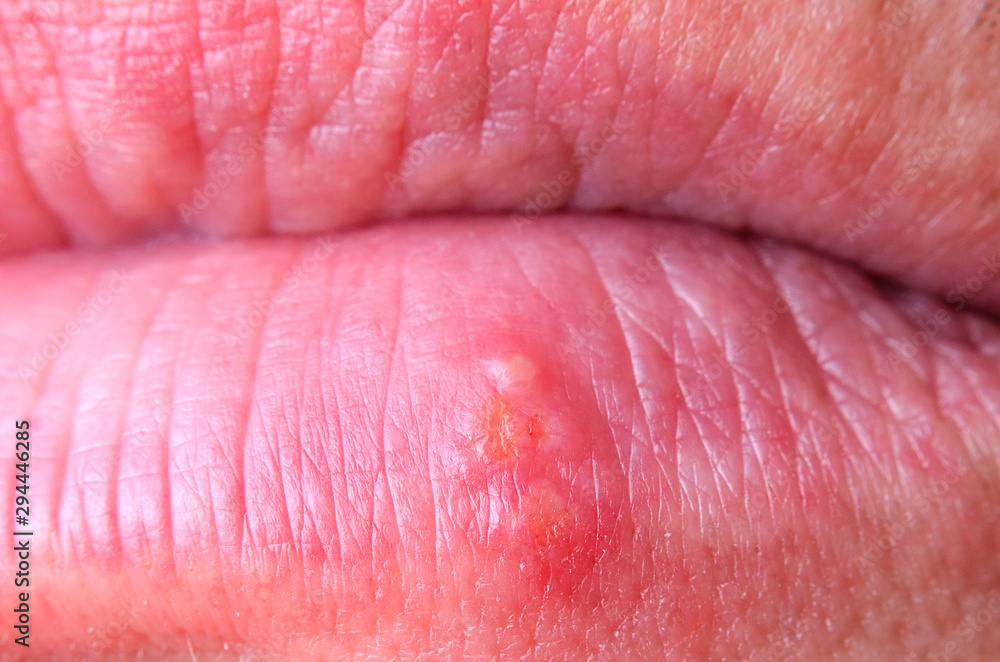 Fototapeta premium Herpes virus on the lower lip of an adult male close-up