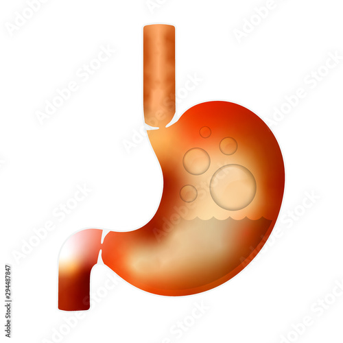 Gas pain & acid reflux