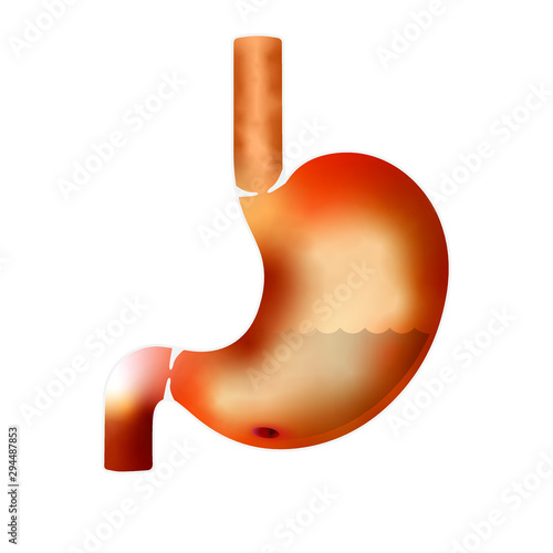 Fotografie Peptic ulcer