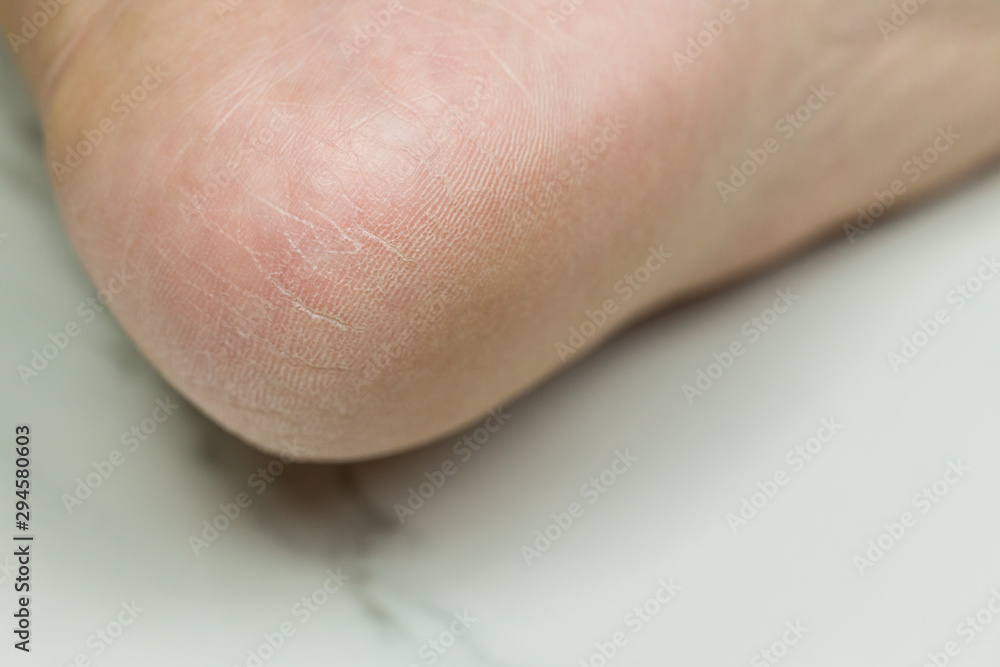 Feet that need a pedicure. Woman cracked heels with white background, foot healthy concept. Dry cracked skin of woman feet in bed. Foot treatment. Feet that need a pedicure. Woman cracked heels with white background, foot healthy concept. Dry cracked skin of woman feet in bed. Foot treatment.