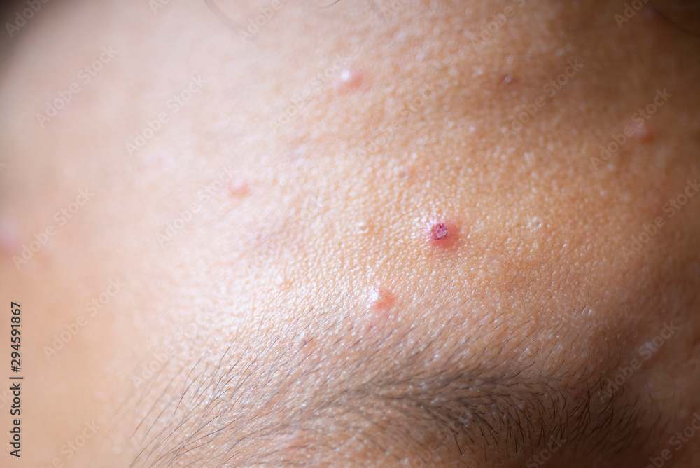 Fototapeta premium Blisters that are inflamed on the skin