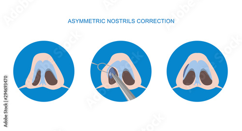 Correction of asymmetric nostrils. Rhinoplasty surgery vector. Implant. Vector illustration.