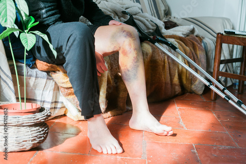 woman with a large hematoma on her leg photo