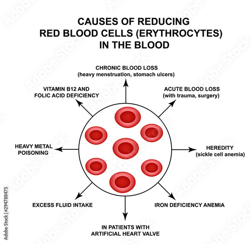 Causes of Reducing Red Blood Cells. Cells erythrocytes. Hemoglobin. The structure of red blood cells. Infographics. Vector illustration on isolated background.