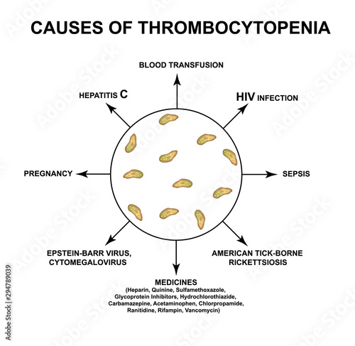 Causes of thrombocytopenia. Reducing platelets in the blood. Infographics. Vector illustration on isolated background.