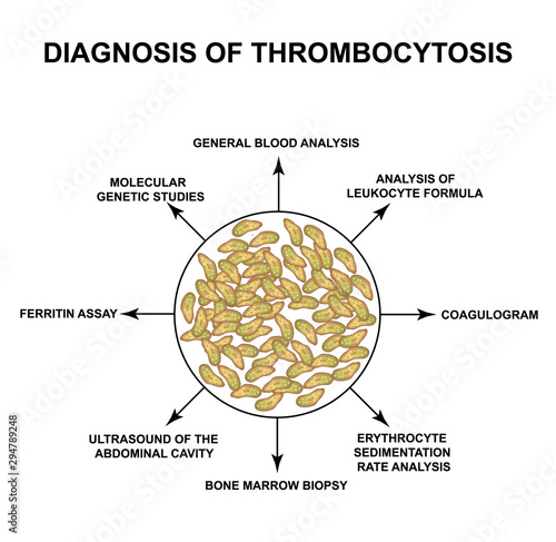 Diagnosis of thrombocytosis. An increase in platelets in the blood. Infographics. Vector illustration on isolated background.