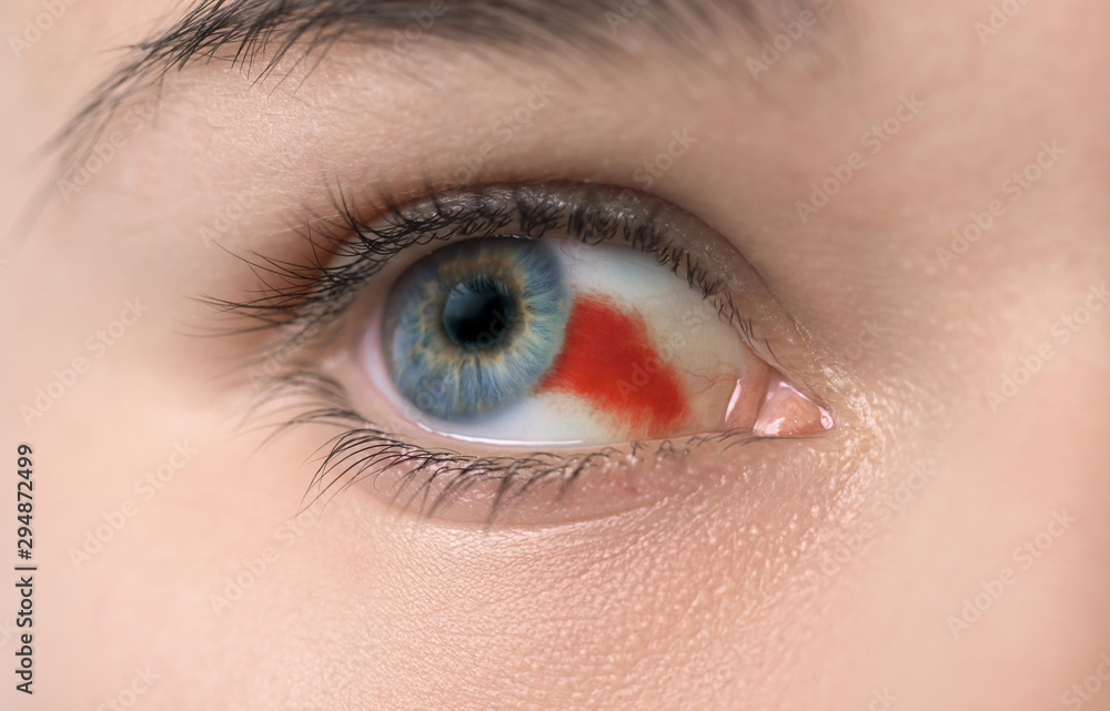 Young woman with burst blood vessel in eye, closeup Young woman with burst blood vessel in eye, closeup