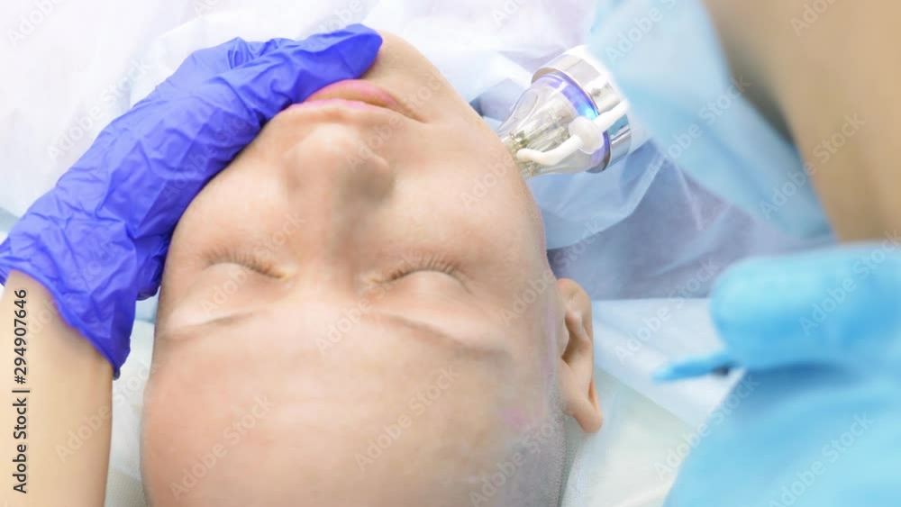 close-up. microneedle RF lifting procedure. Hardware cosmetology. Beautician conducts a facial rejuvenation procedure for a bald woman. close-up. microneedle RF lifting procedure. Hardware cosmetology. Beautician conducts a facial rejuvenation procedure for a bald woman.