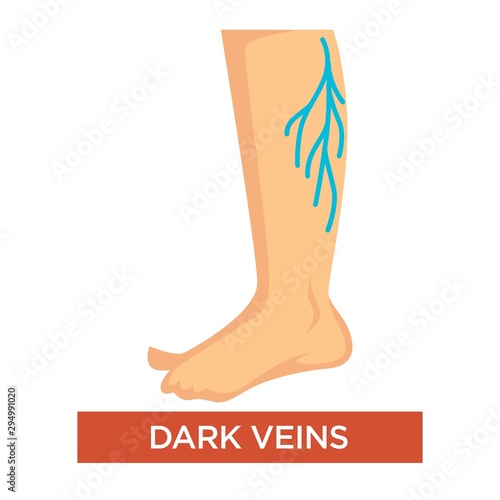 Dark varicose veins on legs symptom with feet close up