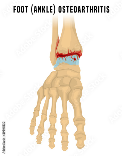 Foot arthritis image