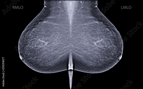 X-ray Digital Mammogram or mammography is x-ray image of the breast in women for screening  Breast cancer. photo