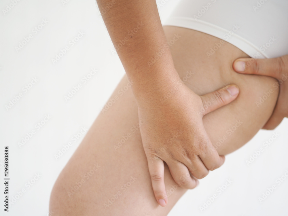 cellulite and orange peel in asian woman and she holding and pushing her leg cause of fatty from weight use for body firming gel or cream product or liposuction concept.