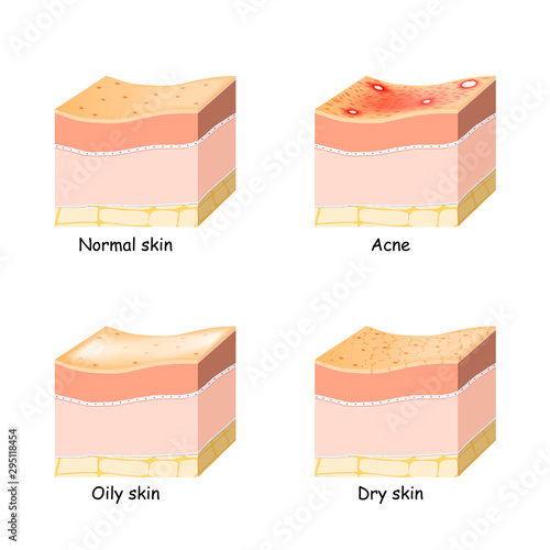 Normal, dry and oily skin. Acne. Skin disorder.