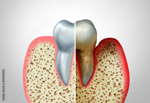Gum Disease photo