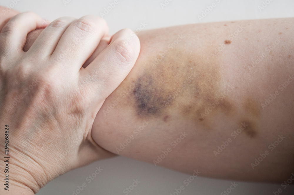 large hematoma on human arm large hematoma on human arm