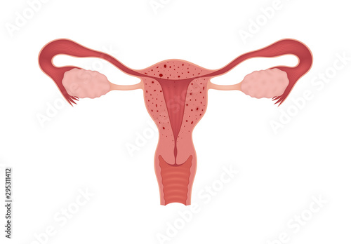 Adenomyosis. Sick female reproductive system isolated on white background. Сross section of an internal organ.
