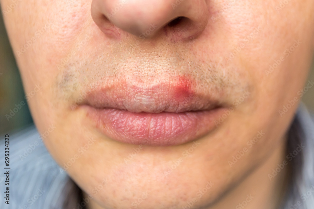 red inflammation and herpes zoster virus on upper male lip red inflammation and herpes zoster virus on upper male lip