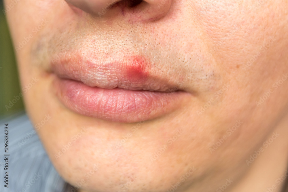 red inflammation and herpes zoster virus on upper male lip red inflammation and herpes zoster virus on upper male lip