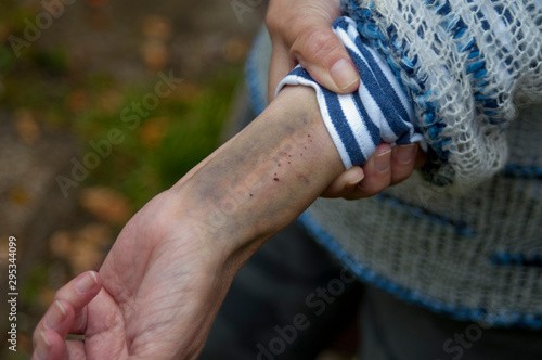 Deep bruise on a hand © vectorass