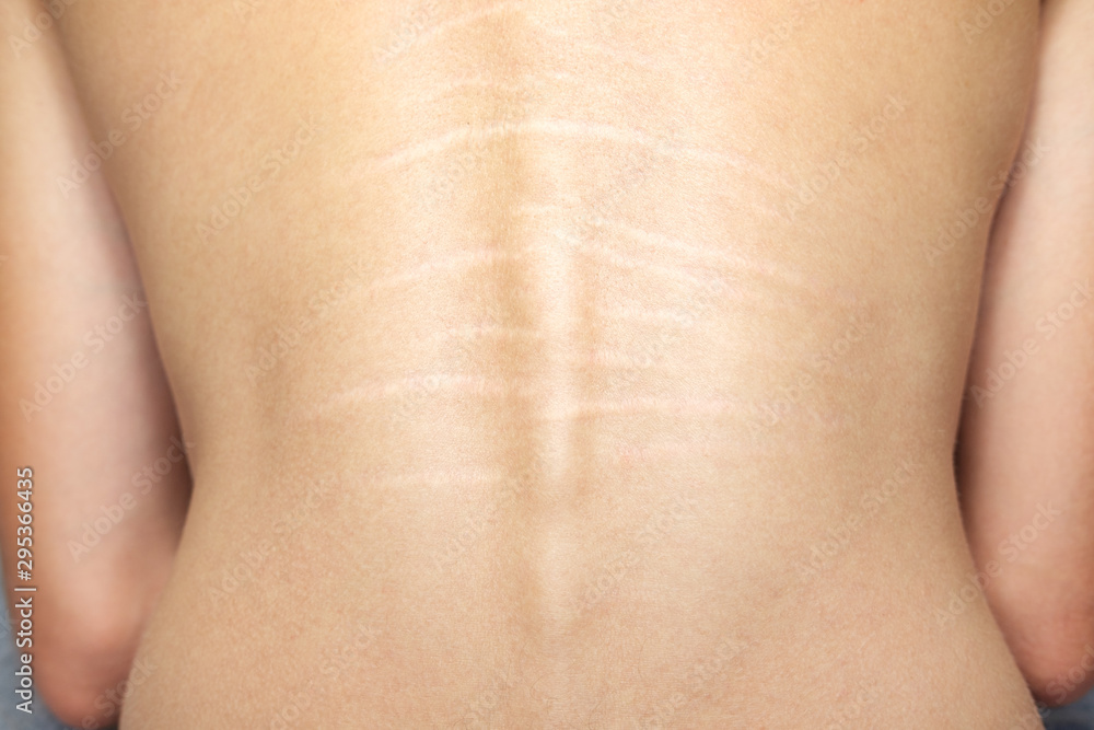 Close up view of the back with .stretch marks on the skin. The concept of  impaired skin elasticity during puberty Stock Photo