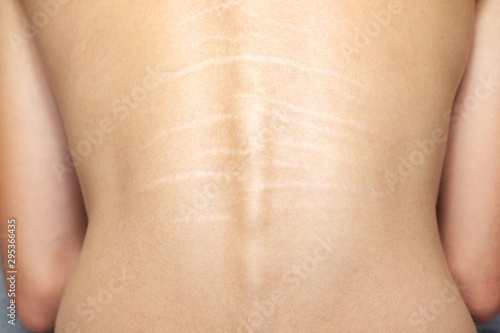 Close up view of the back with .stretch marks on the skin. The concept of impaired skin elasticity during puberty photo