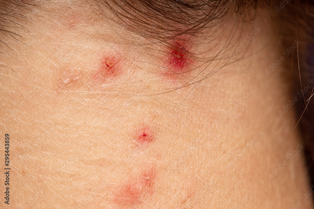 Fototapeta premium Squeezed pimples on female skin close up