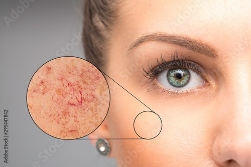 Tableau sur toile Woman face skin imperfection, capillaries in zoom circle