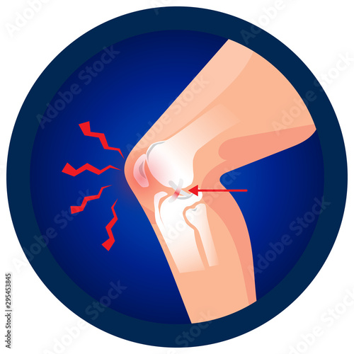 ACL injury of knee icon. Vector flat design for radiology orthopedic research hospital for body joints, orthopedic, sport medicine, diagnostics or corrective therapy. Vector illustration