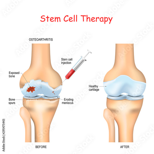 Stem cell therapy for pain in osteoarthritis