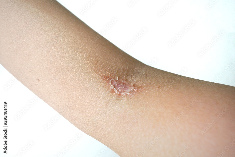 Inflammatory purulent dermatitis caused by allergies and sheep scratching Inflammatory purulent dermatitis caused by allergies and sheep scratching