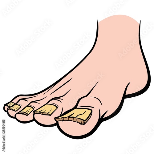 Nail Fungus - A cartoon illustration of a foot with Nail Fungus.