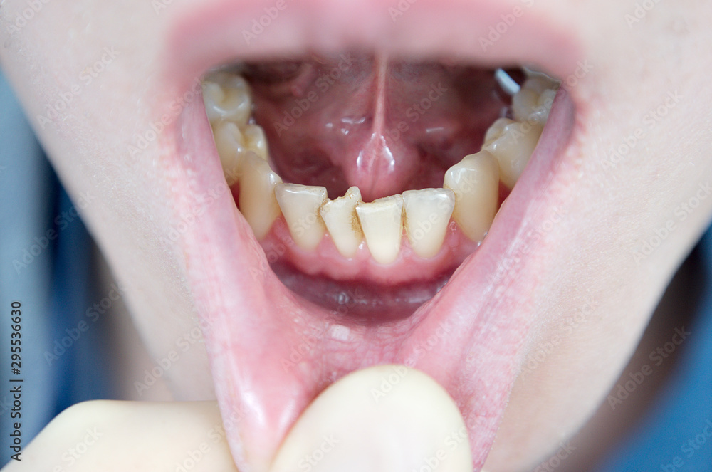 crooked teeth on the lower jaw, crowding of teeth in the anterior part