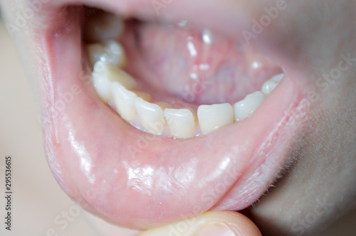 the patient on examination at the dentist, oral examination close-up, dentistry, diastema on the lower jaw, the gap between the teeth