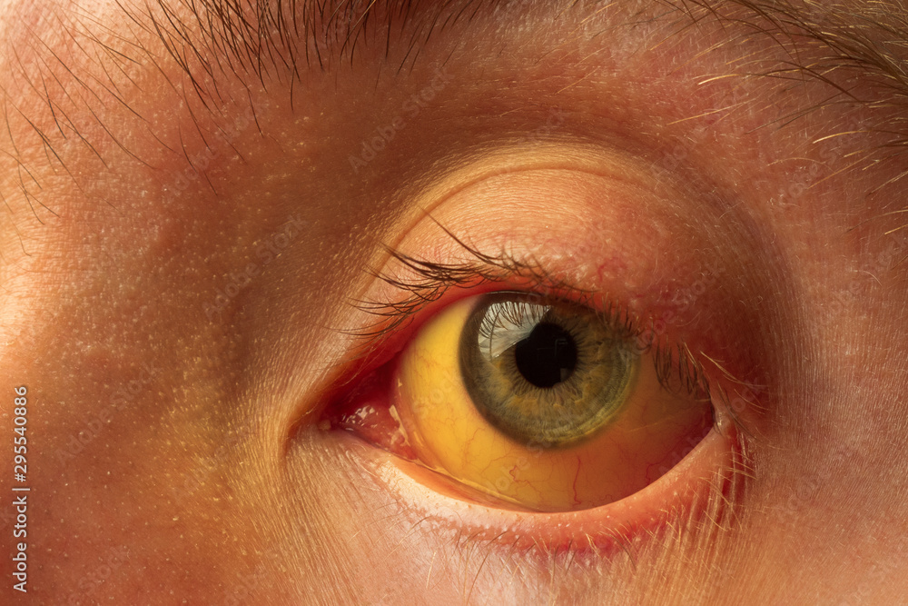 Foto de yellow staining of the sclera of the eye in diseases of the