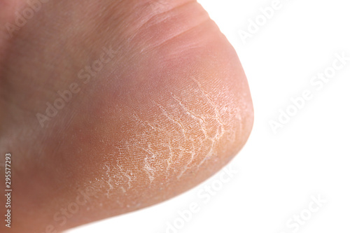 The heel of the foot with bad skin is covered with cracks
