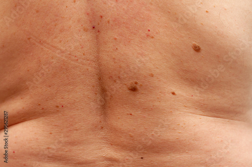 male back with many moles photo